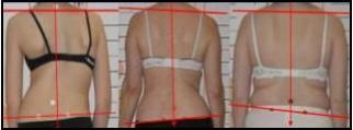 Drei Frauen mit sichtbaren Haltungsschieflagen im Rückenvergleich